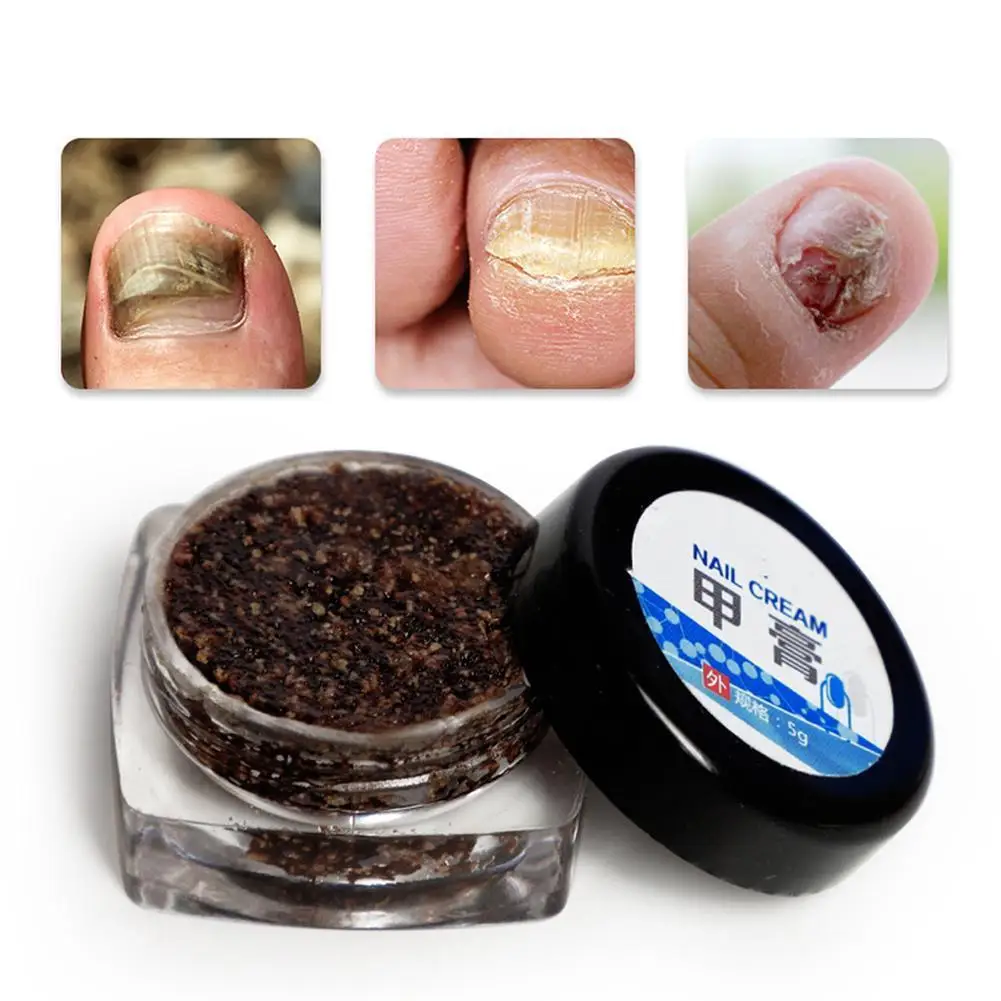 

Onychomycosis Paronychia Repair Cream Toe Nail Anti Fungal Repair Ointment Herbal Fungus Removal Infection Care Nail Treatm Y3E1