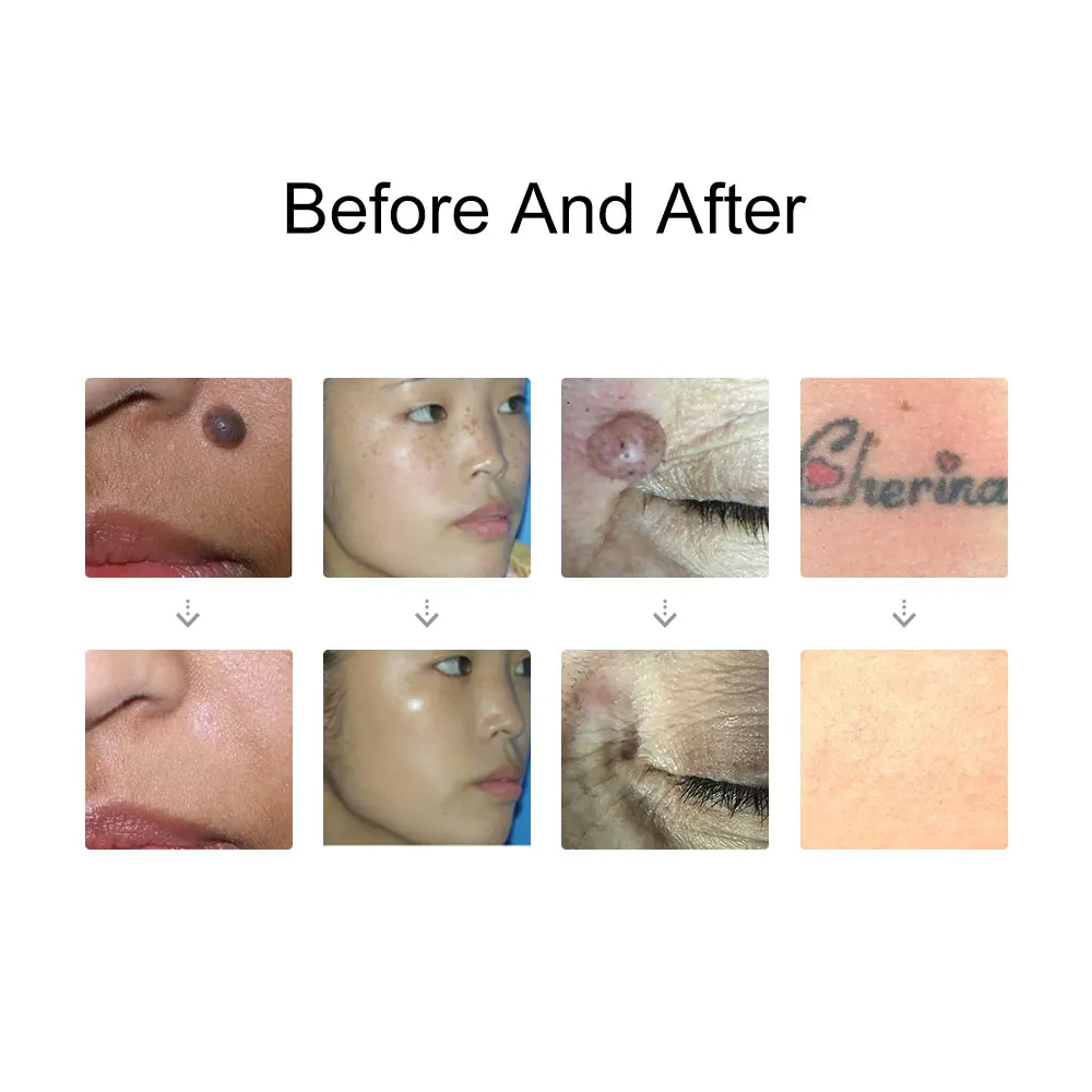 Laser Picosecond Pen Freckle Tattoo Removal Aiming target Locate Position Mole Spot Eyebrow Pigment Remover Acne Beauty Care