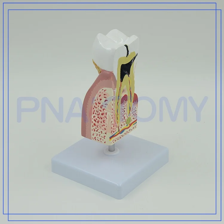 

Enlarged Human Teeth Care Model Tooth Decay Dental Caries Medical Student Medical Supplies Teaching Resources Anatomical Model