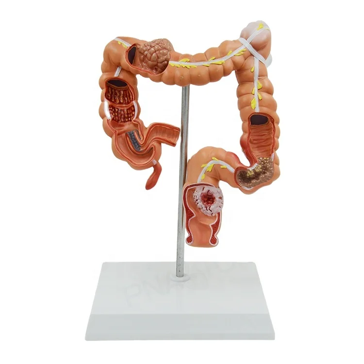 

Human Digestive System Organ Anatomy Diseased Large Intestines PNT-07451 Medical Supplies and Equipment Anatomical Model