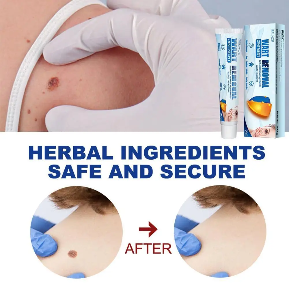 

20g Wart Cream Skin Tag Remover Antibacterial Cream Micro Ointment Mole Wart Body Face Care Herbal Extract Ointment