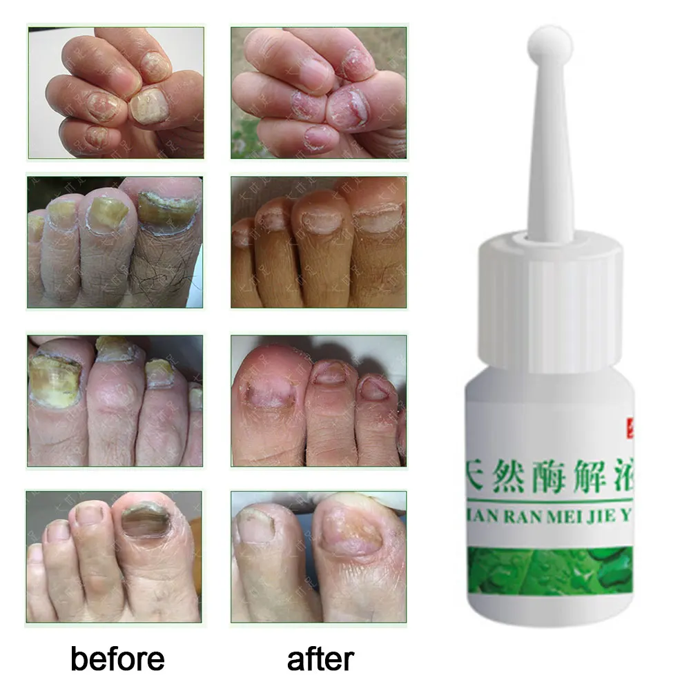 Onychomycosis удобное портативное безболезненное удаление ногтей энзиммолиз жидкость Leuconychia жидкость Ringworm эфирное масло Leuconychia