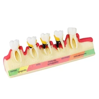 dental disease model m4010 caries model demonstrates progress of periodontal disease m4010 dental study teeth model for dentist