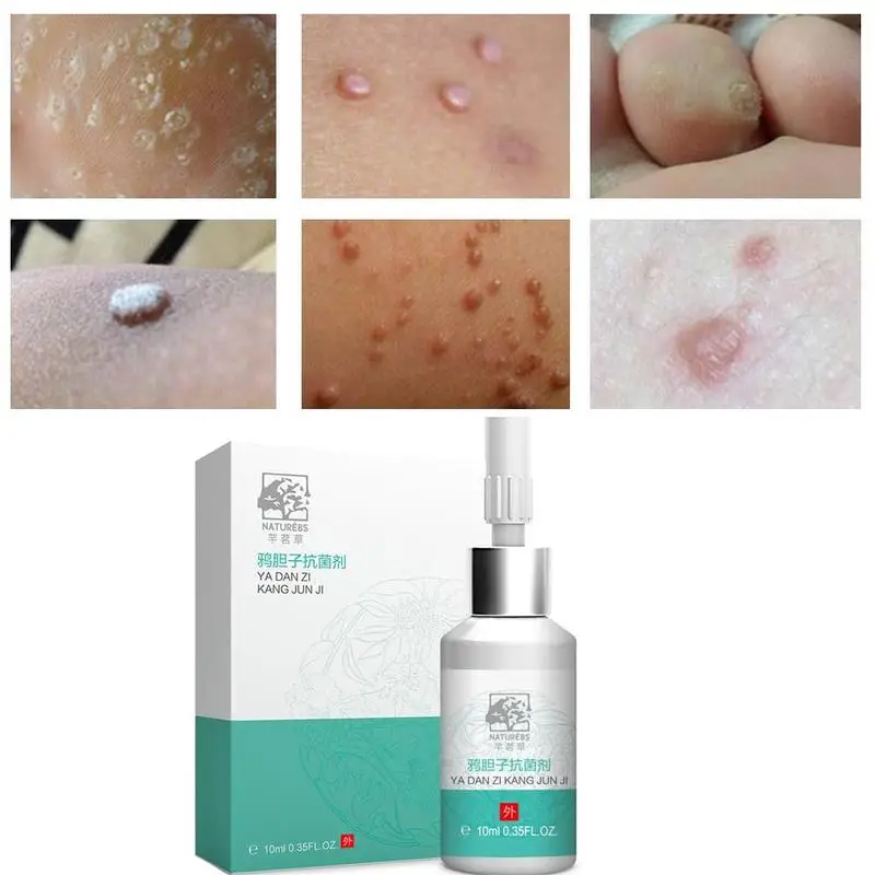 10 мл Антибактериальный раствор 0f для рук и ног тела Кукурузные коконы бородавки