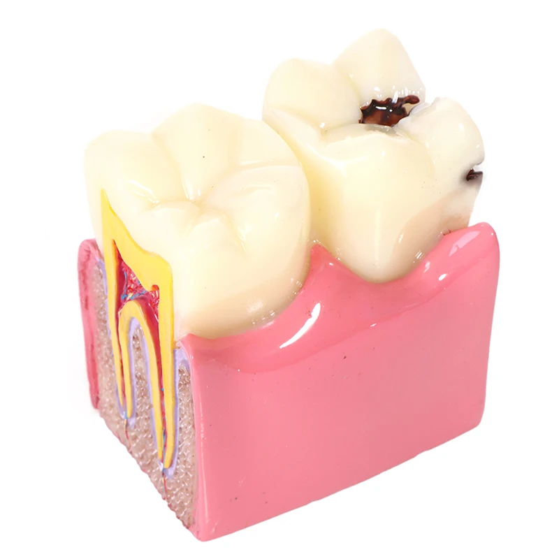 

1pcs dental teeth model 6 Times Caries Comparation Study denture Tooth models Dentist Studying and Researching Dentistry product