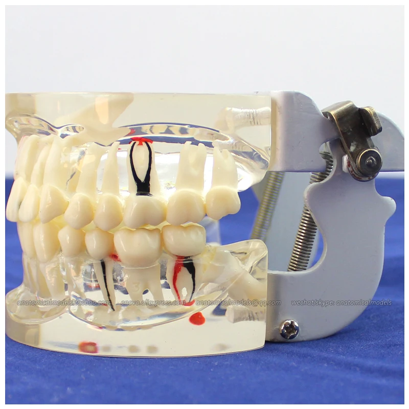 

CMAM/12566 Dental- Pathological dental model, demo, Human Oral Dental Medical Teaching Anatomical Model