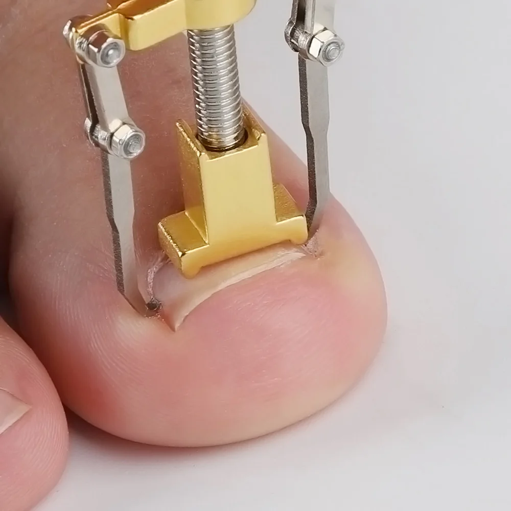 Инструменты для коррекции вросших пальцев пилочка ногтей набор выпрямления и