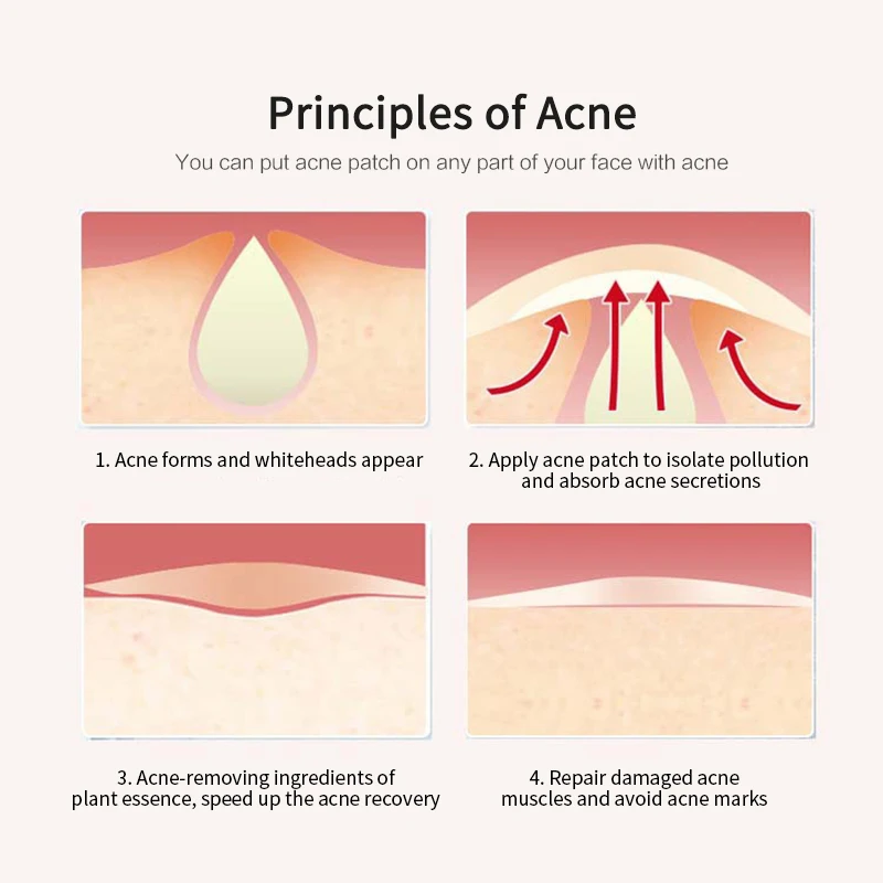 36 шт. Патчи от акне es Remover патчи прыщиков лечение защита для поврежденных участков