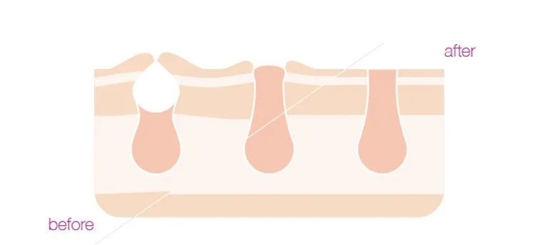 Melsya IPL лазер для удаления волос Eepilator машина для перманентного удаления безболезненных волос устройство для удаления акне