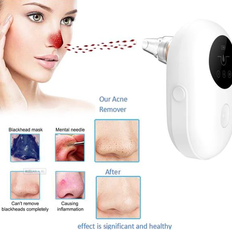 Электрический аппарат для удаления чёрных точек на лице | Инструменты