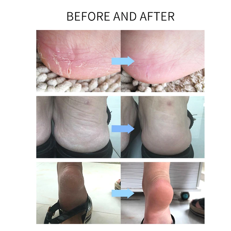 Увлажняющие гелевые спа-носки профессиональные для увлажнения и смягчения