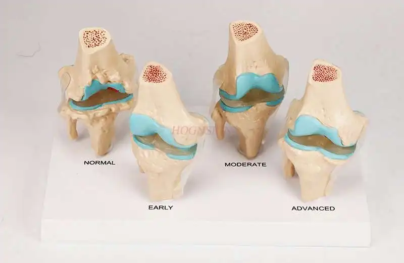 Human knee degeneration / lesion demonstration model Skeletal model Functional human joint model