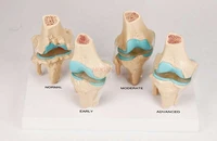 human knee degeneration lesion demonstration model skeletal model functional human joint model