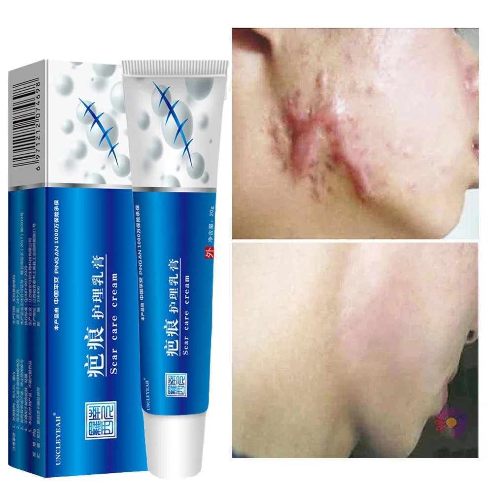 Крем для удаления шрамов от акне прыщей растяжек гель лица удаление сглаживание