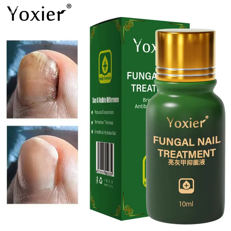 

Fungal Nail Treatment Serum Remove Onychomycosis Paronychia Anti-Fungal Anti Infection Herbal Nourish Repair Foot Nail Care 10ml