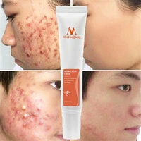 acne scar removal cream gel herbal anti acne treatment fade acne spots whitening moisturizing oil control shrink pores skin care