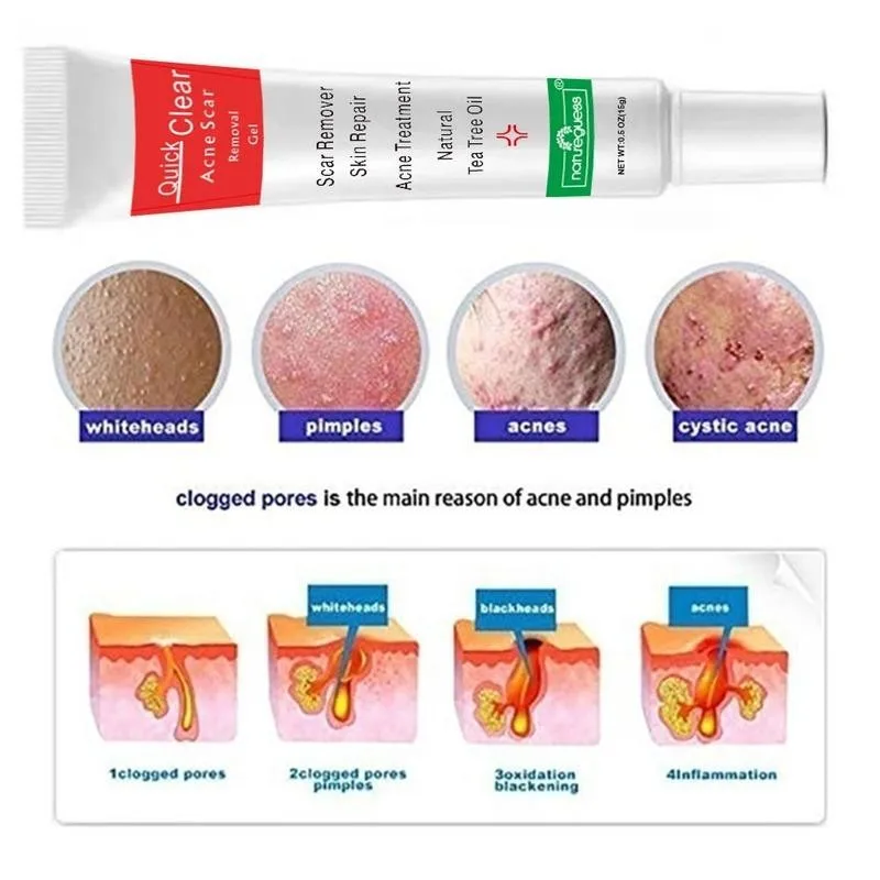 

Beauty Acne Cream Acne Treatment Face Cream Scar Blackhead Remover Shrink Pores Oil Control Natural Skin Care