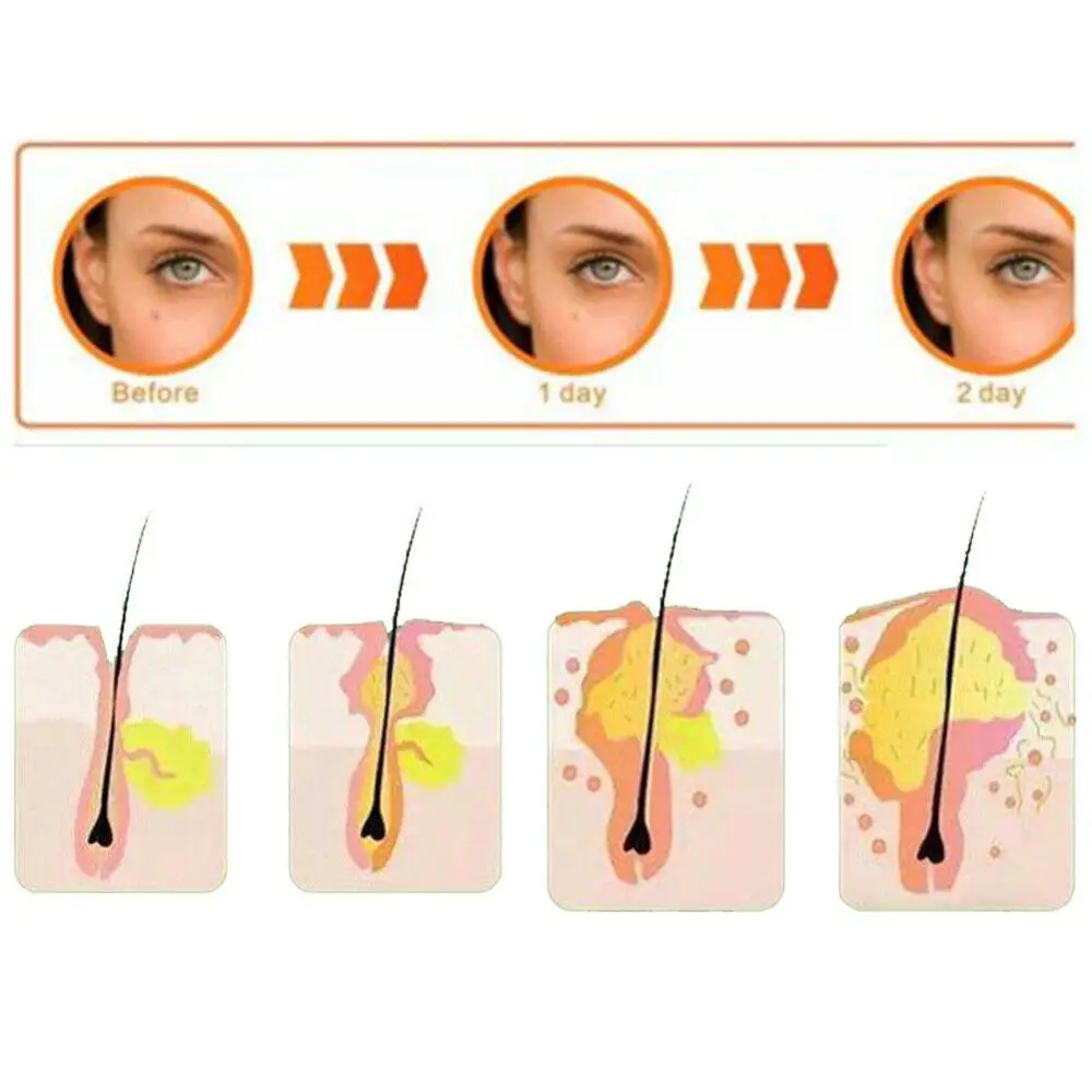 40PCS Acne Pimple Patch Face Mask Acne Treatment Serum Face Cream Acne Cream Essence Sheet Facial Care Tools