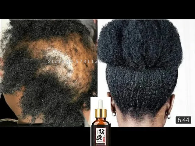 

Fast Wild Growth Hair Serum Oil Treatment for Hair Loss Natural Essence for Men Women EXTREME REPAIR For Bald spots