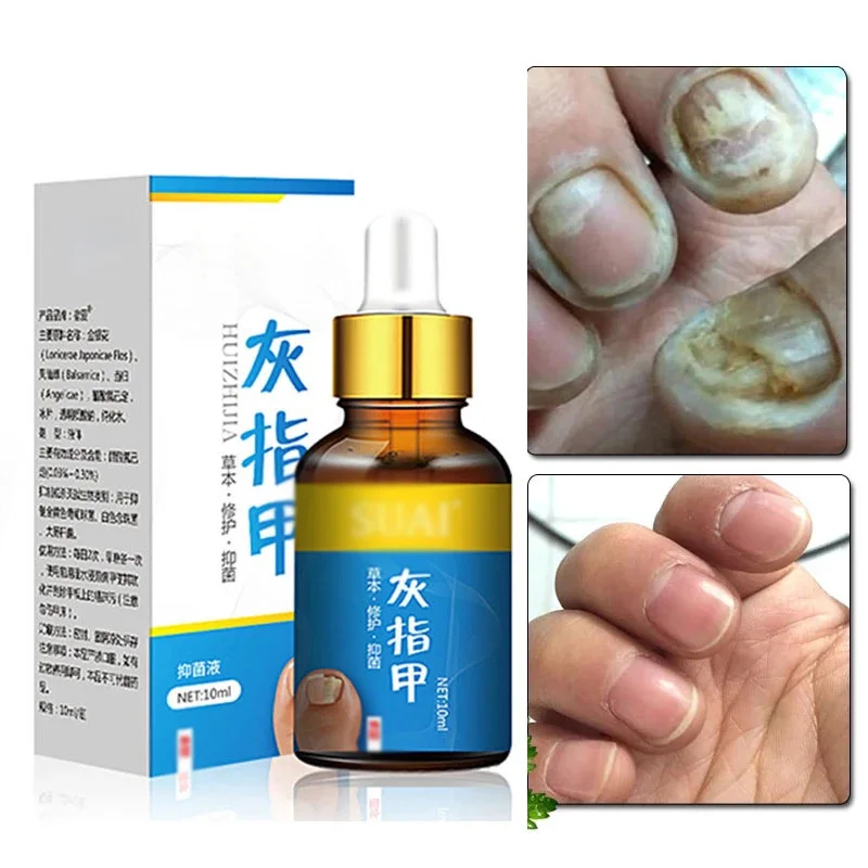 

Onychomycosis special soft nail peeling care essence 10ml to remove bad nail thickening cream bright nail paronychia onychomycos