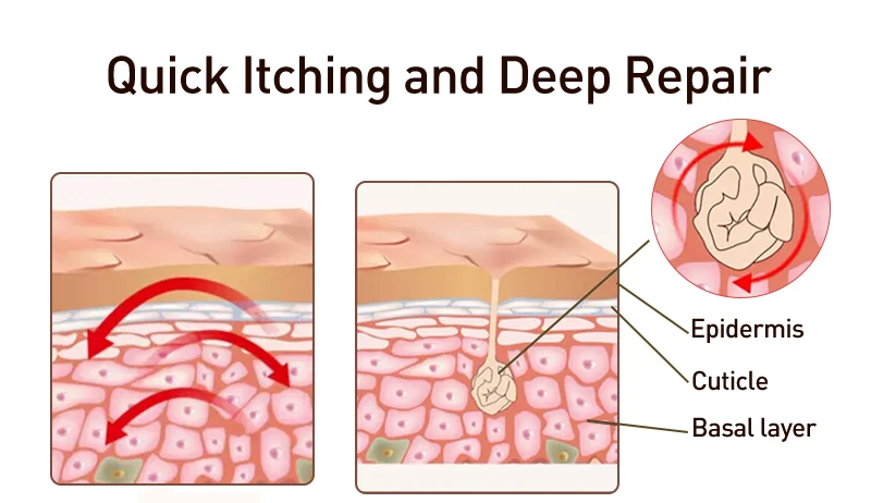 100% оригинальный крем от псориаза Антибактериальный противозудный дерматит