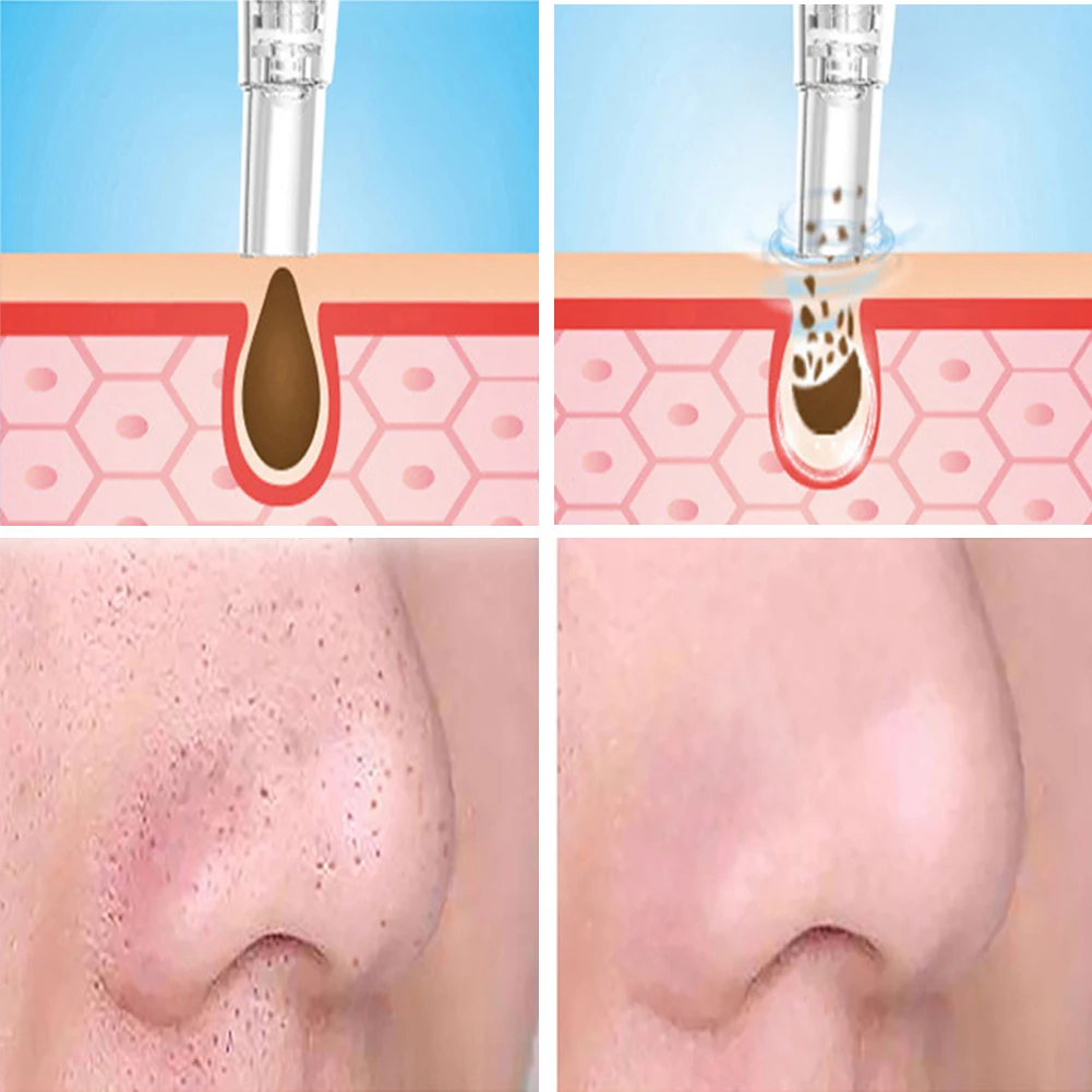 Очиститель пор глубокое очищение омертвевшей кожи средство для удаления угрей