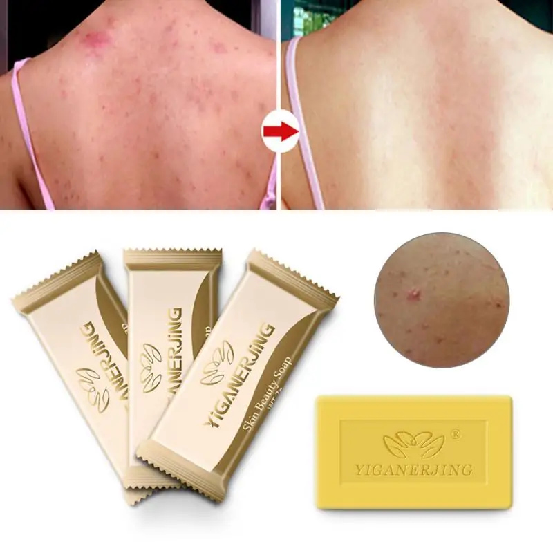 Мыло для удаления прыщей ПОР угрей серы и средство черных точек мыло ухода за