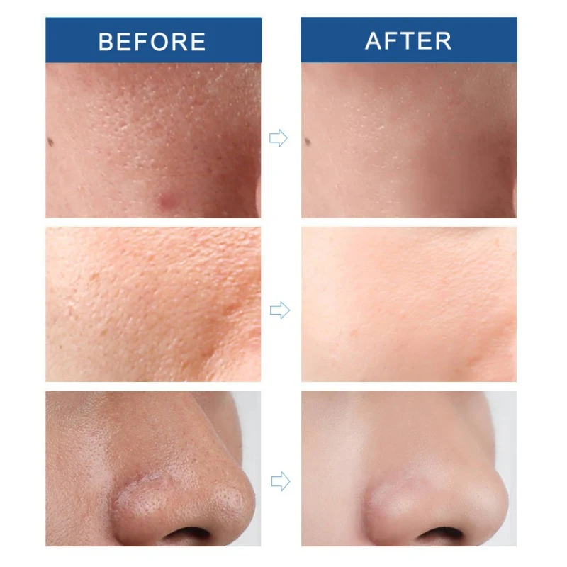 Эффективная Сыворотка для сужения пор укрепляющая кожу удаляет черные точки