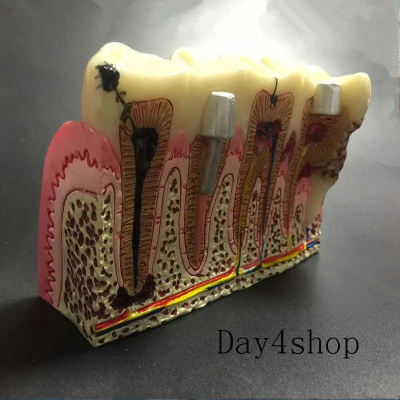 Стоматологическая модель кариеса общая патологий обучения стоматологический