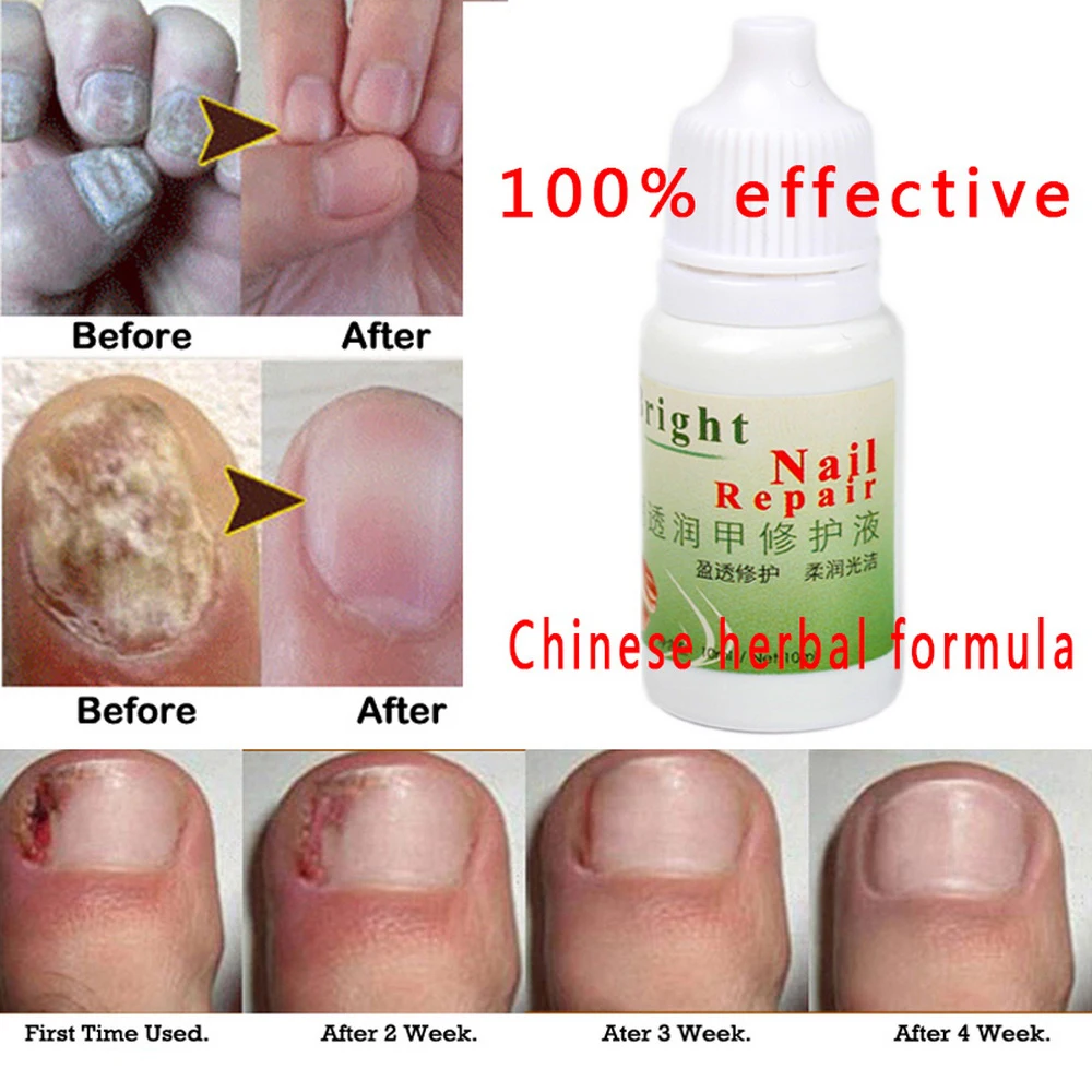 Крем для лечения грибка от паронихии и онихомикоза 100% 10 мл | Красота здоровье
