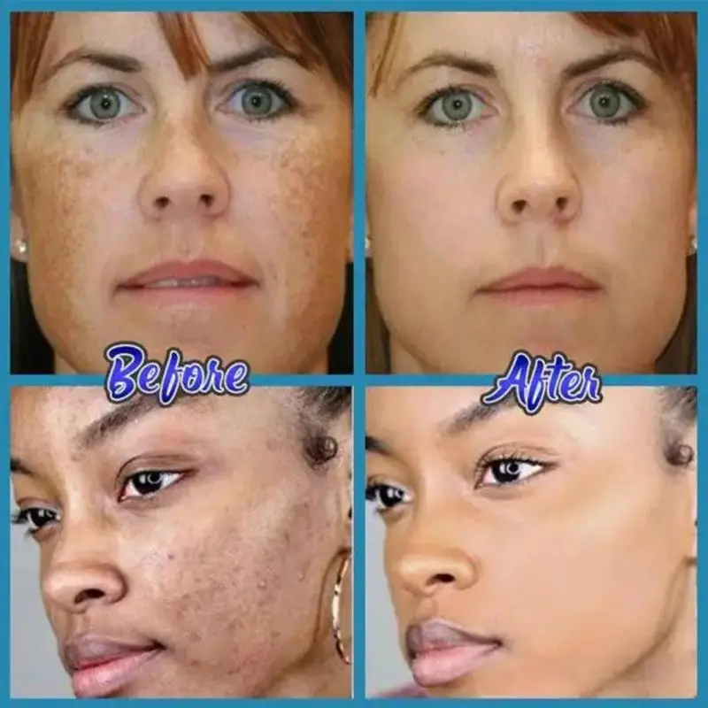 Natural Herbal Topical Cream Face Pimples Scar Stretch Marks Removal Acne Cream Whiten Face Skin Care Treatment