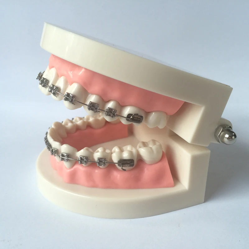 Стоматологическая Ортодонтическая модель с кронштейнами | Красота и здоровье