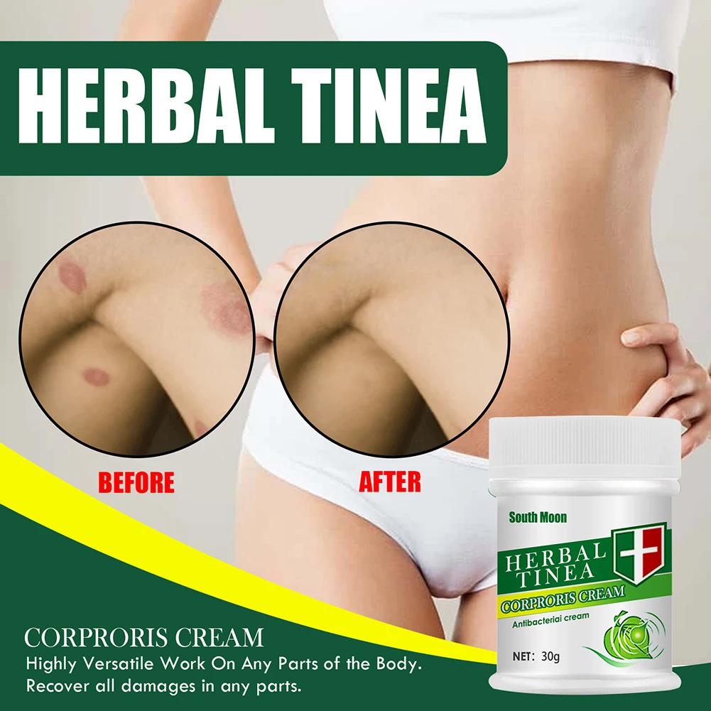 

Effective Herbal Tinea Cream Fungal Anti-fungal Ointment Infections Treatment Medicine Cream Health Care Tool