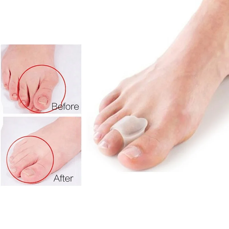 

1-5Pair Bunion Corrector Silicone Toe Separator Hallux Valgus Correction Pedicure Foot Tools Bone Thumb Orthotics Feet Stretcher