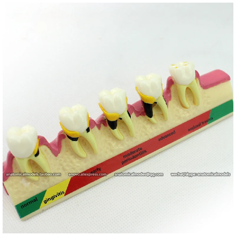 

12585 / Dental Periodontal Disease assort Tooth Typodont Study Model, Medical Science Dental Teaching Models