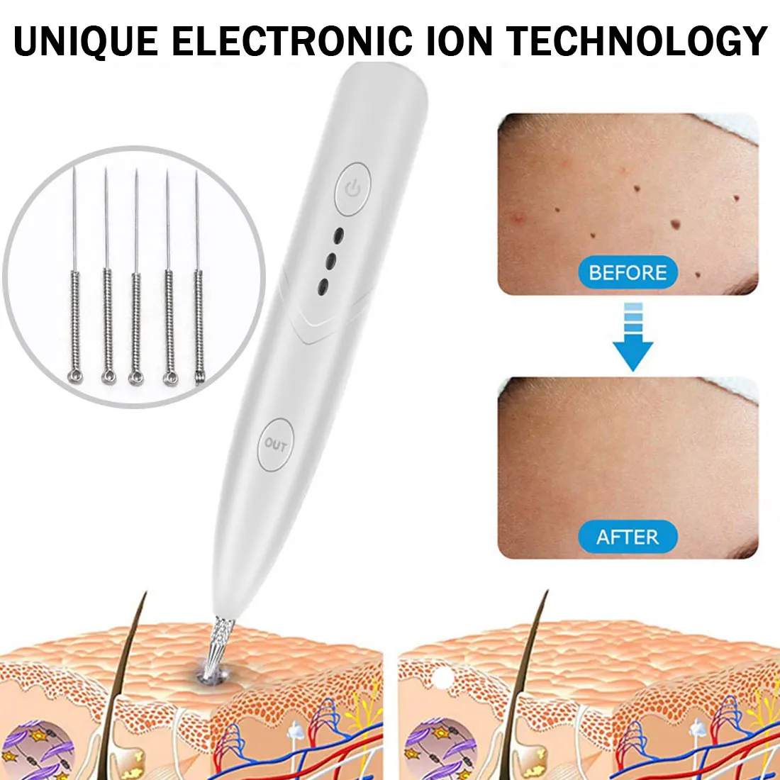 Плазменный резак избавление от веснушек удаления пера средство для бородавок