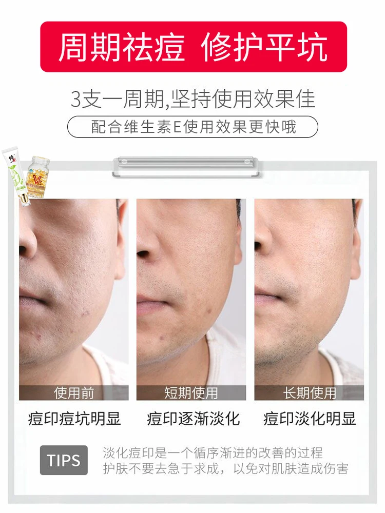 

CX Correction Genuine Anti-Acne Marks Acne Gel Gel Anti-Acne Repair Hydrating Aloe Vera Gel