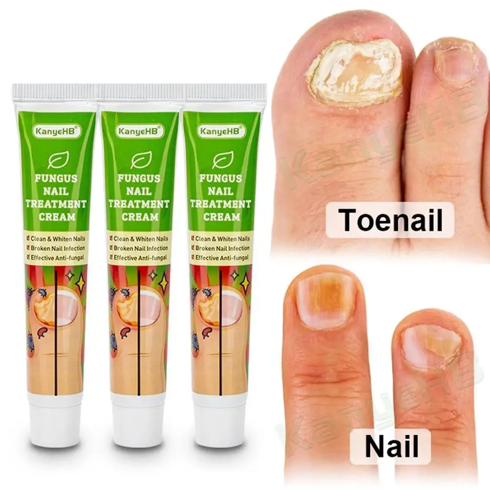 

Nail Fungus Treatment Cream Removal Nail Paronychia Onychomycosis Ointment Feet Whitening Toe Care Plaster