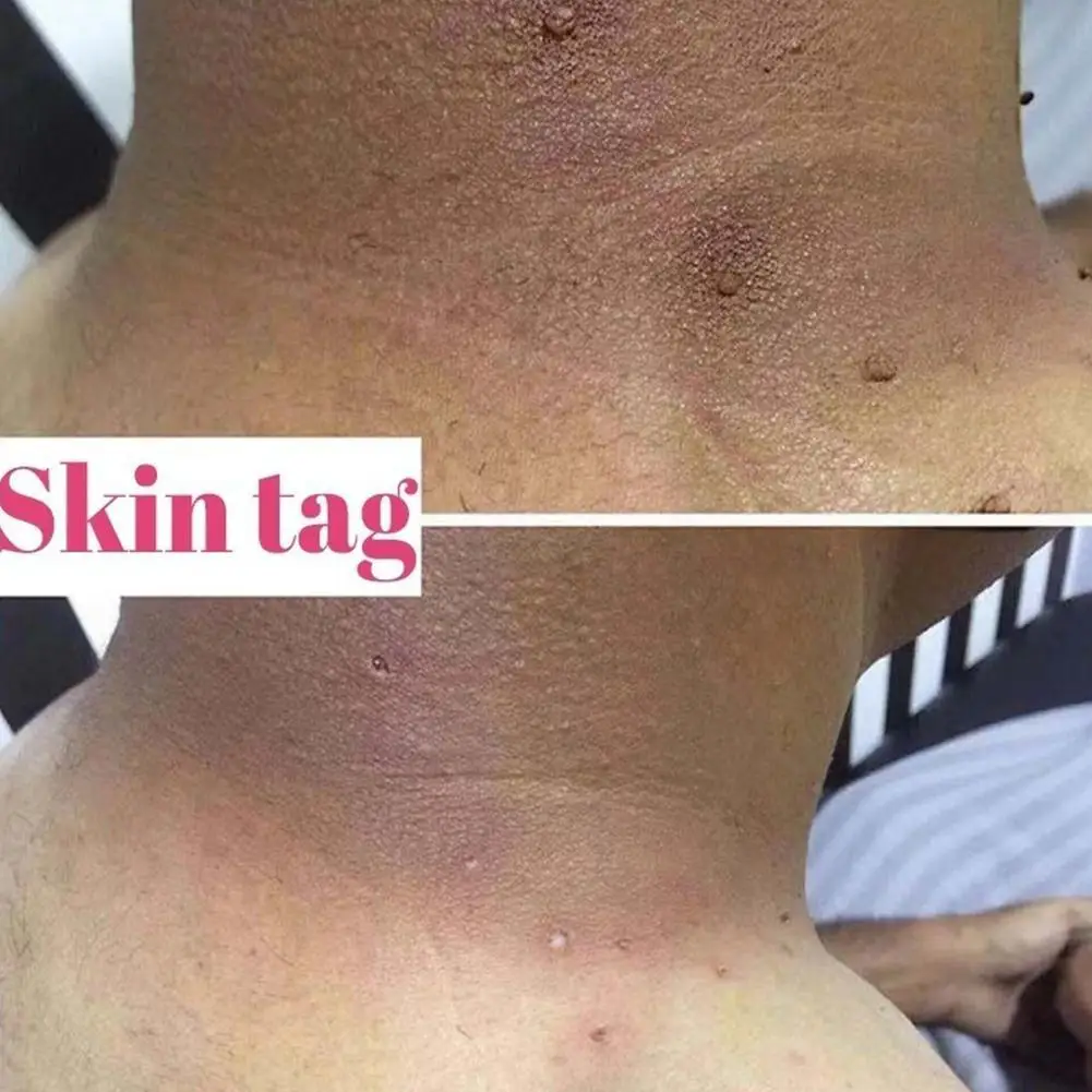 3 мл этикетка для кожи искусственная кожа травяной экстракт сыворотка родинка