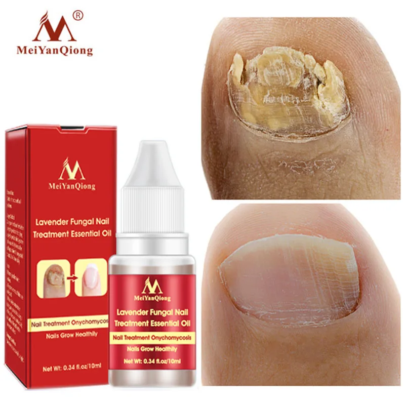 

10ml Fungal Nail Treatment Serum Onychomycosis Paronychia Anti-Fungal Nail Infection Herbal Toe Fungus Foot Repair Essence Care