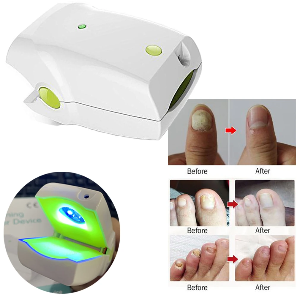 

Light Therapy Device Anti Toenail Fungal Onychomycosis Stop Nail Fungal Infection Nail Fungus Cleaner
