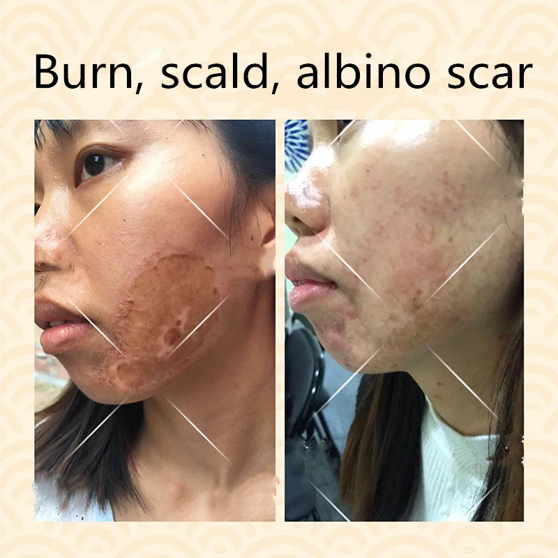 

Remove inflammation and repair the post operation set of albino scar burn
