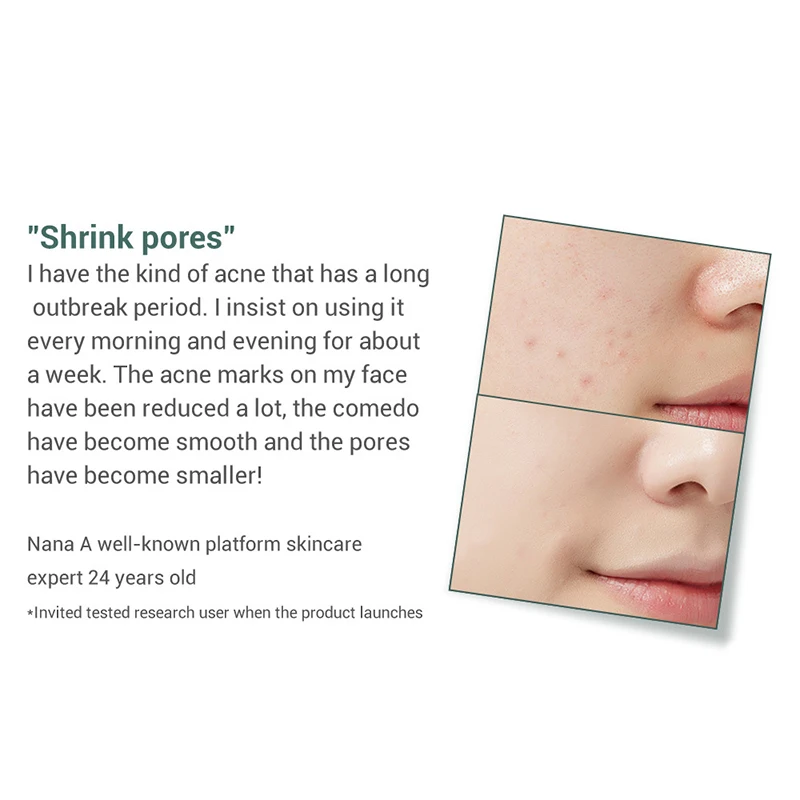 

15ml Acne Liquid Face Pore Shrinking Serum Whitening Moisturizing Treatment Repairing Skin Care Anti Aging Wrinkles Serums L G