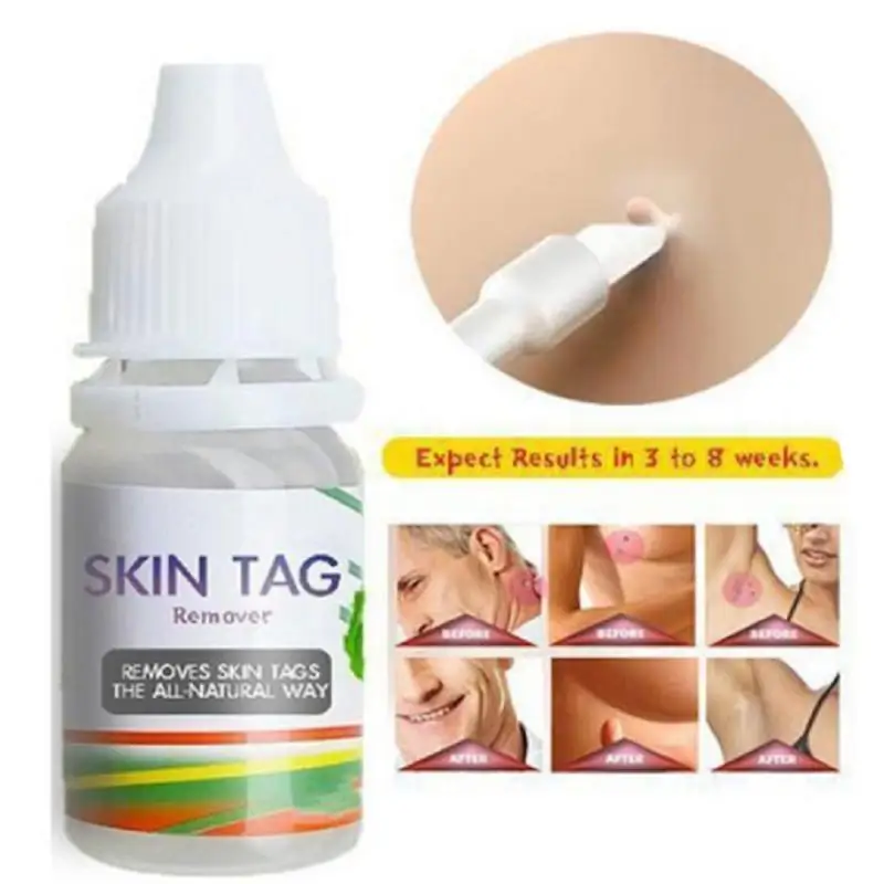 

10ml Skin Tag Remover Foot Corn Warts Treatment Chinese Medicine Skin Warts Removal Plantar warts Care Ointment TSLM2