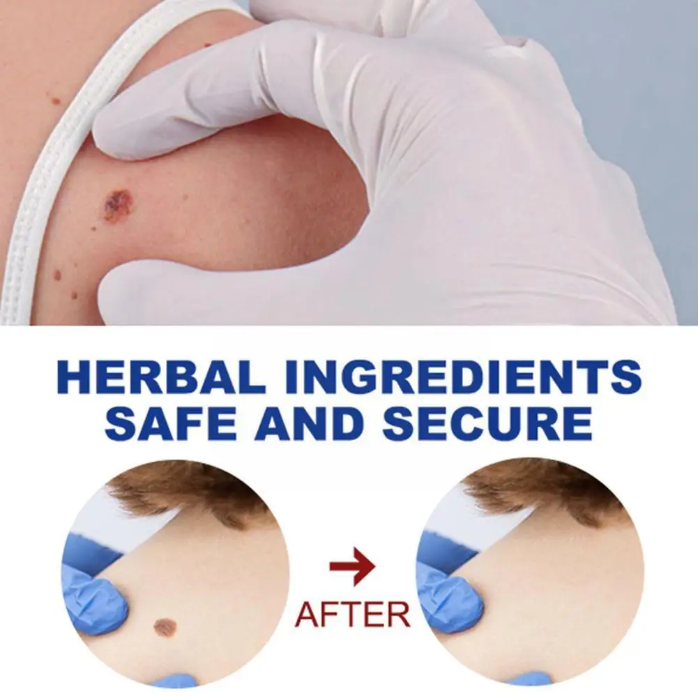 

Removal Genital Wart Treatment Papillomas Skin Tags Moles Effective Remover Removing Rapidly Against Remedy Anti Verruca Z7H8