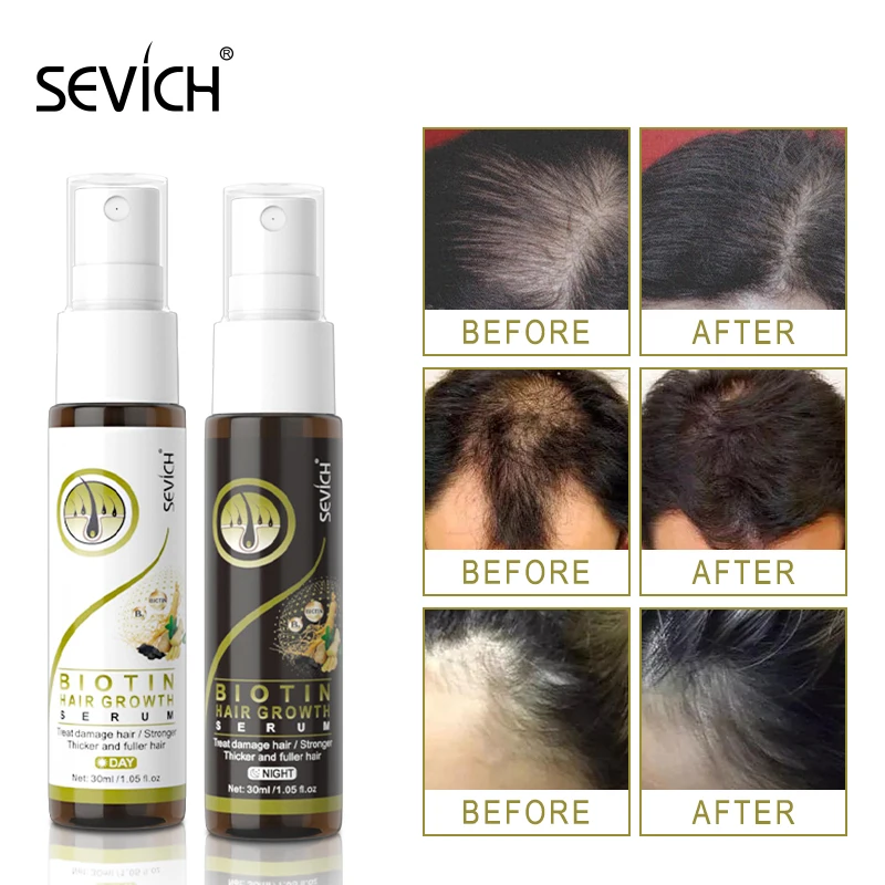 

Sevich Biotin Hair Growth Serum 2pcs/lot Hair Loss Treatment Hair Spray Fast Growing Hair Products Ginger Hair Growth Spray