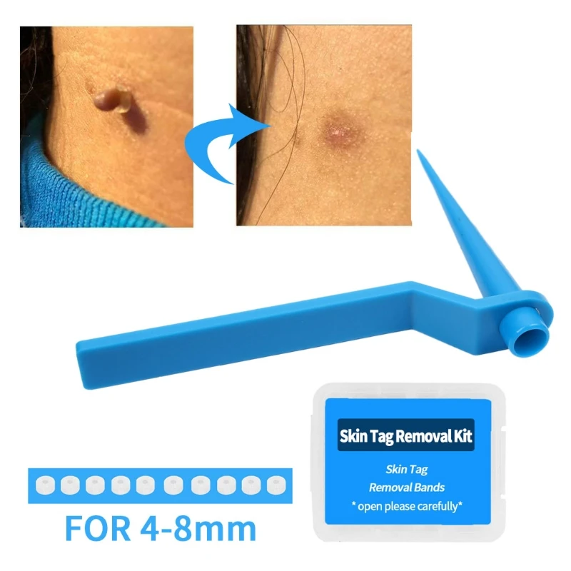 30 Pcs 4-8mm Skin Tag Remover Bands Rubber Device Perfect for Medium/Large Clean Care Easy to Use Painless |