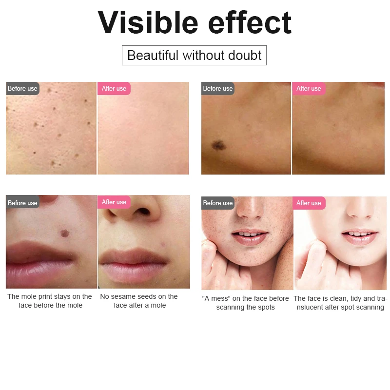 

Laser Plasma Mole Remover Pen LED Lighting Pores Tattoo Freckle Removal Sweep Spot Wart Skin Care Face Cleaning Beauty Machine