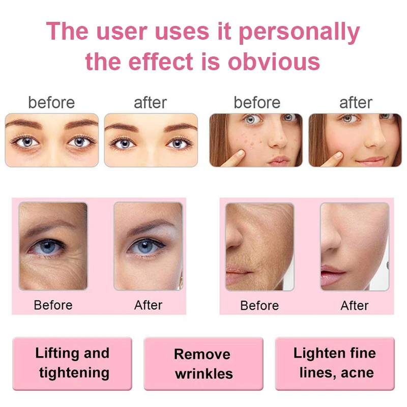 Радиочастотный EMS мезотерапия 2 цвета Электропорация лифтинг красота