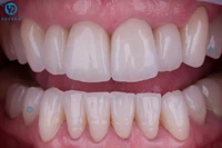 zirconia discs 98mm dental consumables cad cam sht multilayer zirconia disc for arch